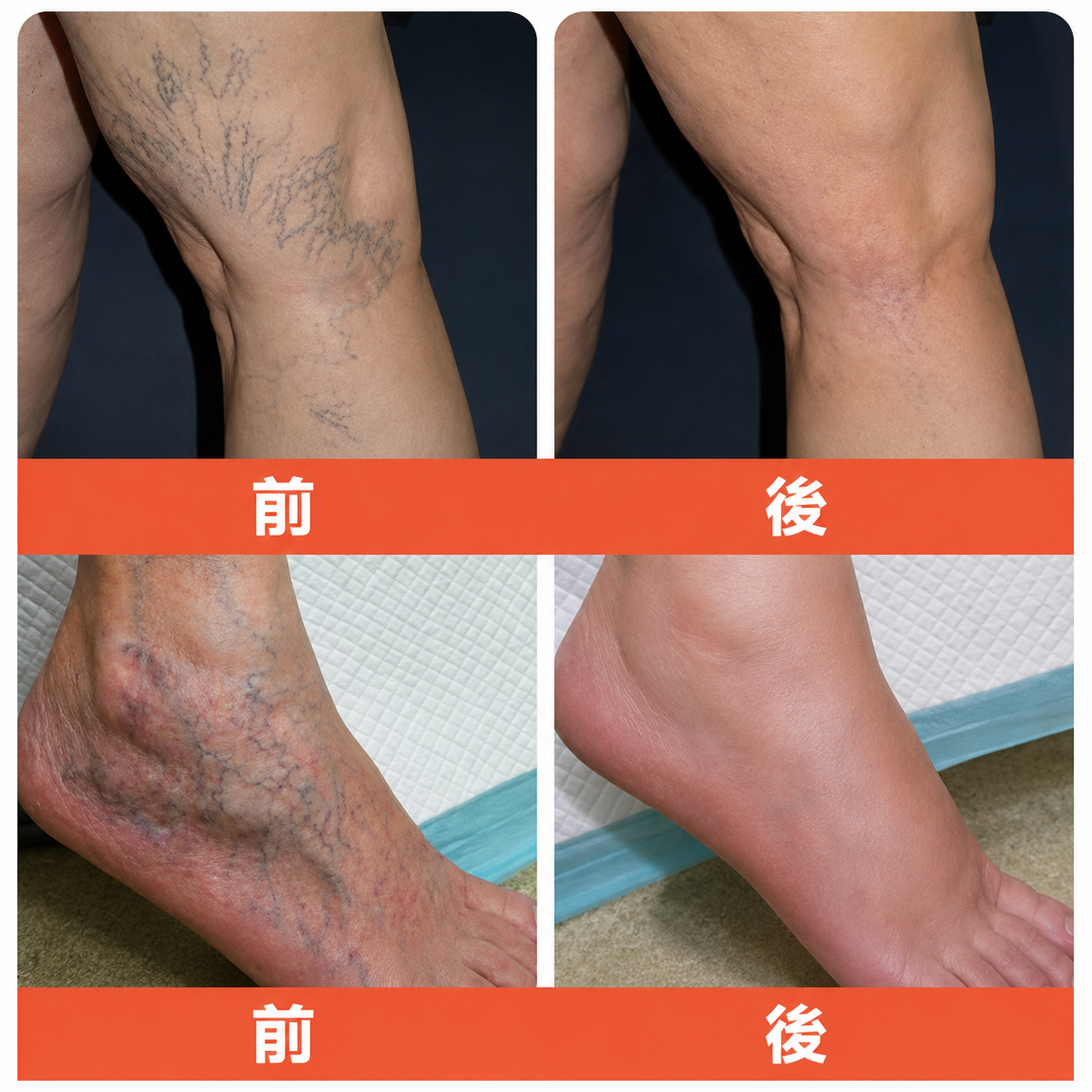 ☘️【厚生労働省認可・GMP準拠】Zvoevo® Vein Ease マイクロニードルケアパッチ（クモ状静脈・静脈瘤・むくみ・脚の疲れに）-  🎯