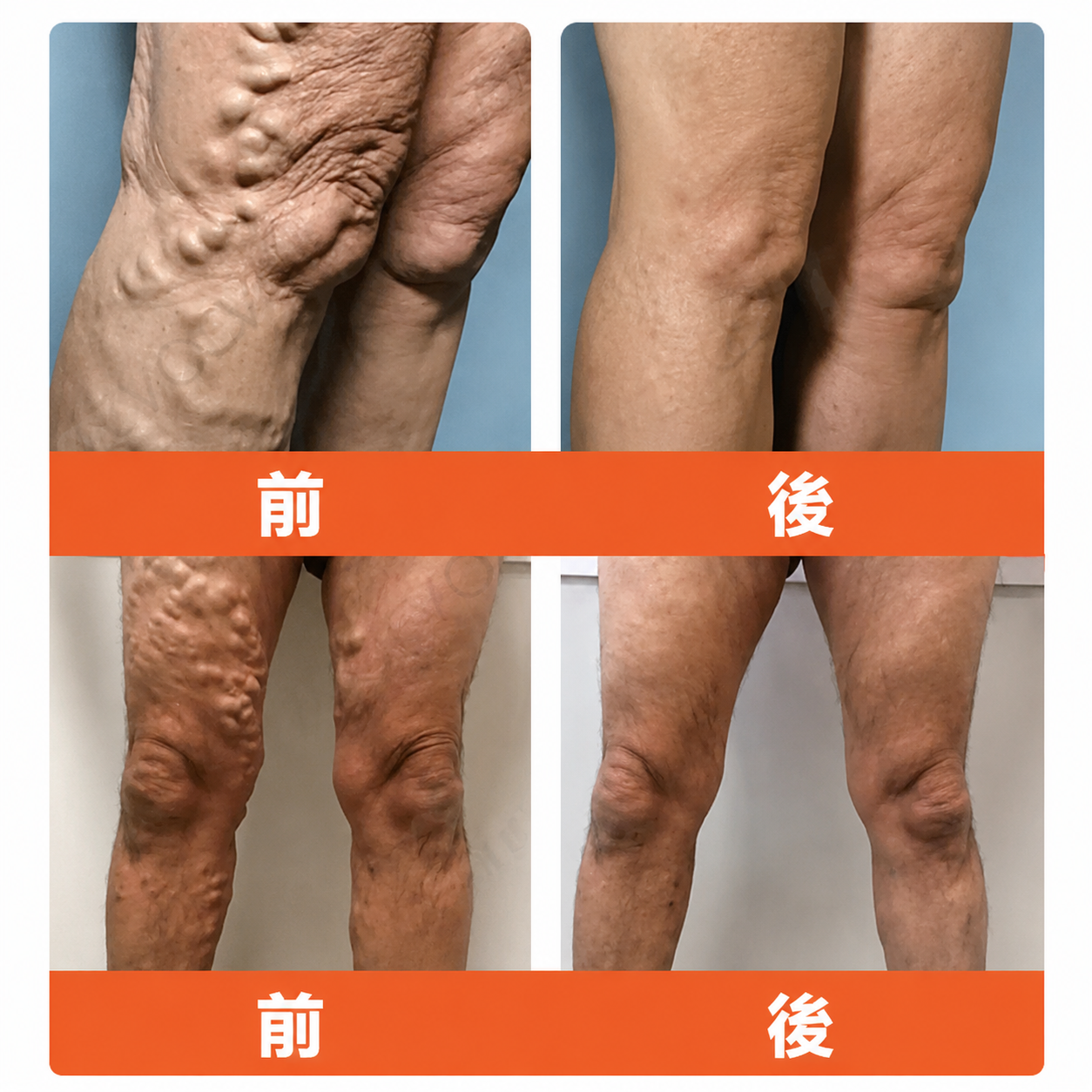 ☘️【厚生労働省認可・GMP準拠】Zvoevo® Vein Ease マイクロニードルケアパッチ（クモ状静脈・静脈瘤・むくみ・脚の疲れに）-  🎯